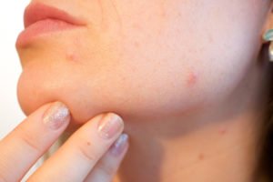 5 Home Remedies for Acne Marks