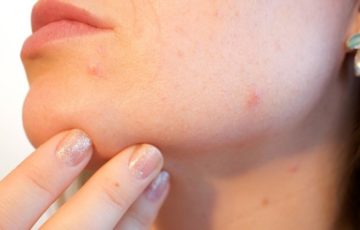 5 Home Remedies for Acne Marks