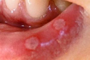 Home Remedies For Mouth Ulcers